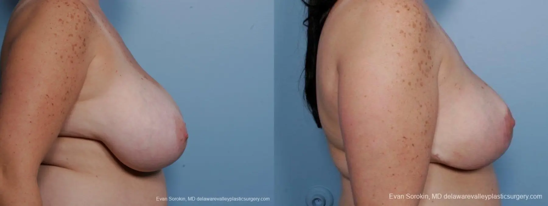 Philadelphia Breast Reduction 8703 - Before and After 5