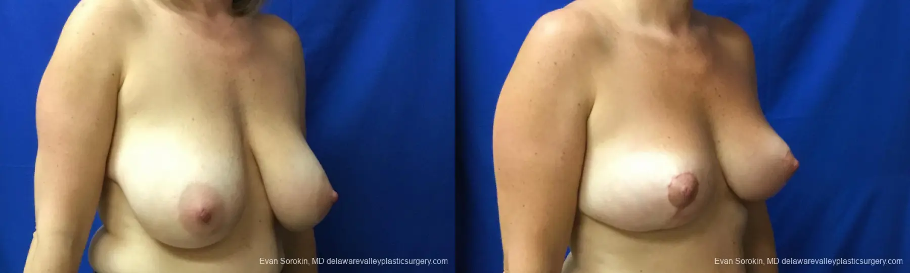 Philadelphia Breast Reduction 12512 - Before and After 2