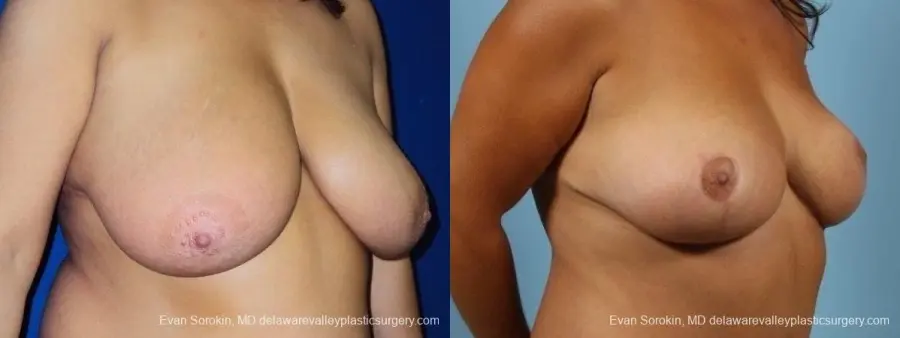 Philadelphia Breast Reduction 8701 - Before and After 2