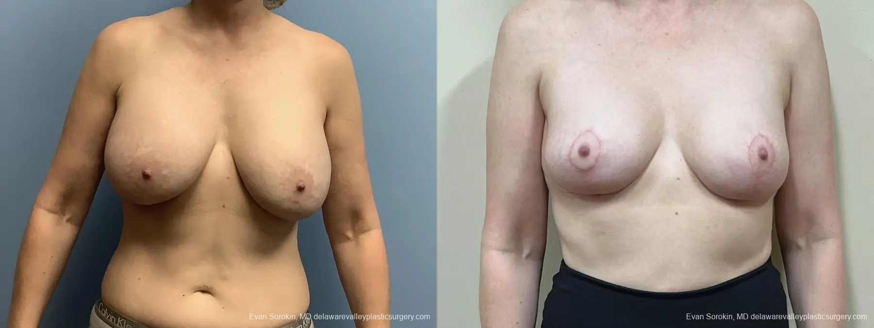 Breast Reduction: Patient 9 - Before and After 1