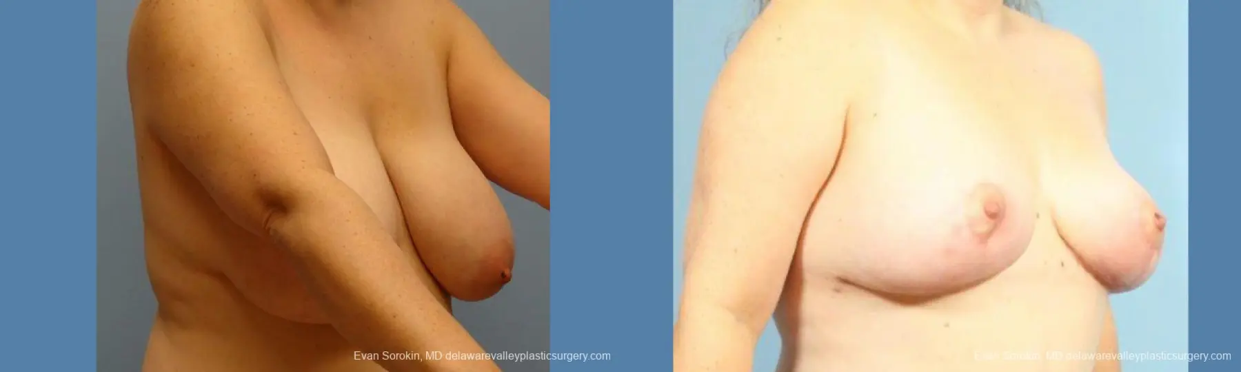 Philadelphia Breast Reduction 9430 - Before and After 3