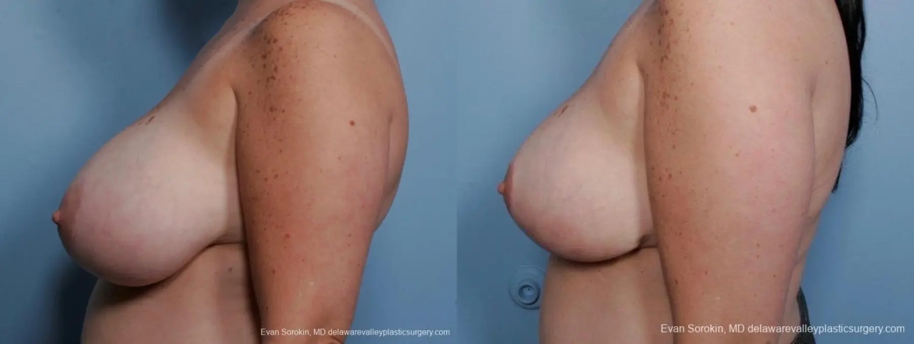 Philadelphia Breast Reduction 8703 - Before and After 4