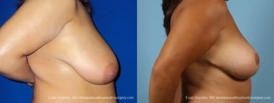Philadelphia Breast Reduction 8701 - Before and After 4