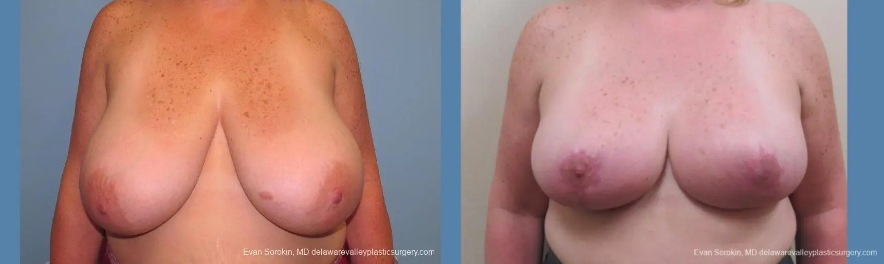 Philadelphia Breast Reduction 10118 - Before and After 1