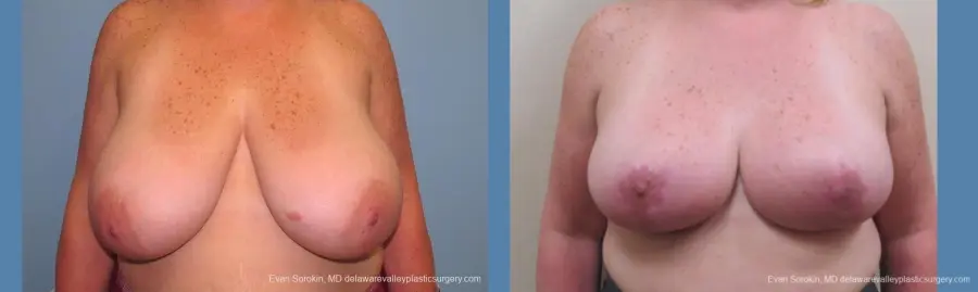 Philadelphia Breast Reduction 10118 - Before and After