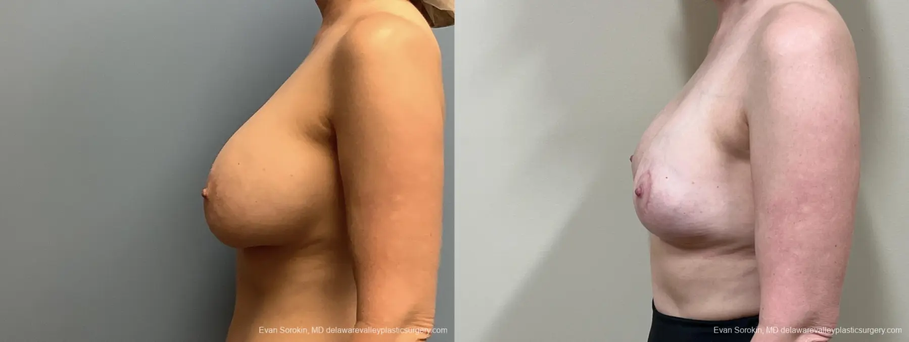 Breast Reduction: Patient 9 - Before and After 5