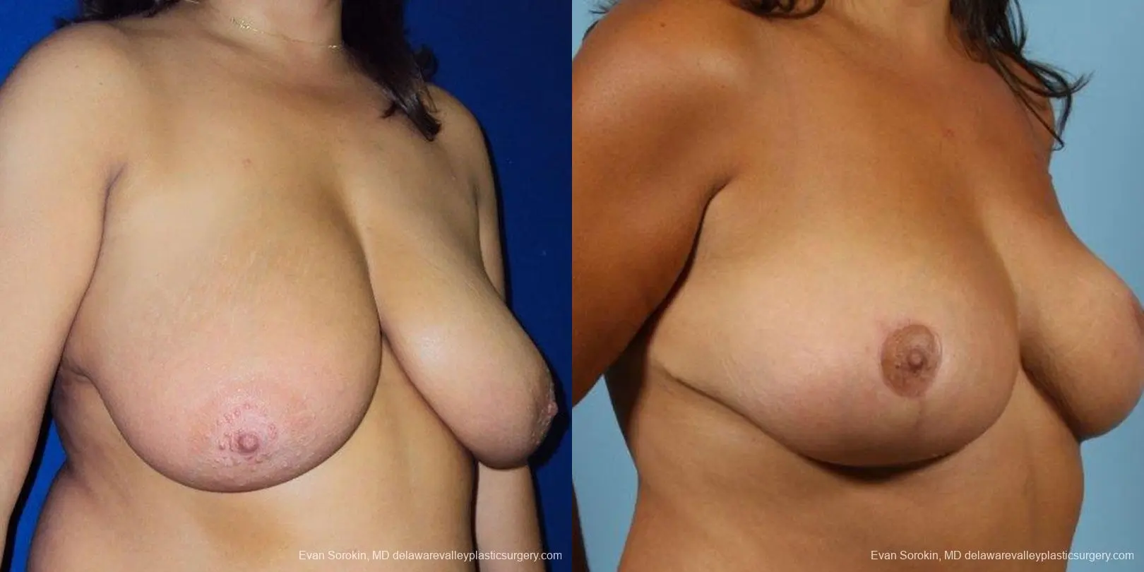 Philadelphia Breast Reduction 9470 - Before and After 4