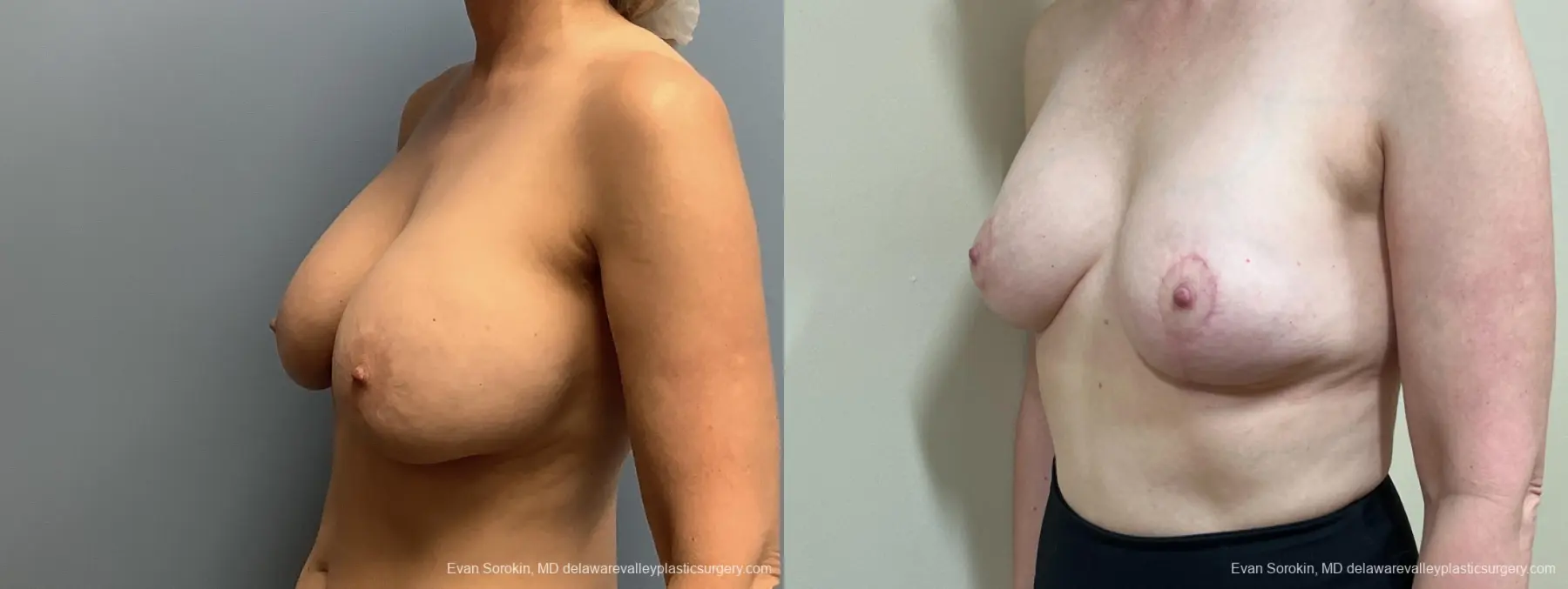 Breast Reduction: Patient 9 - Before and After 4