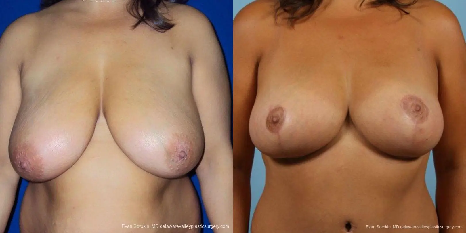 Philadelphia Breast Reduction 9470 - Before and After