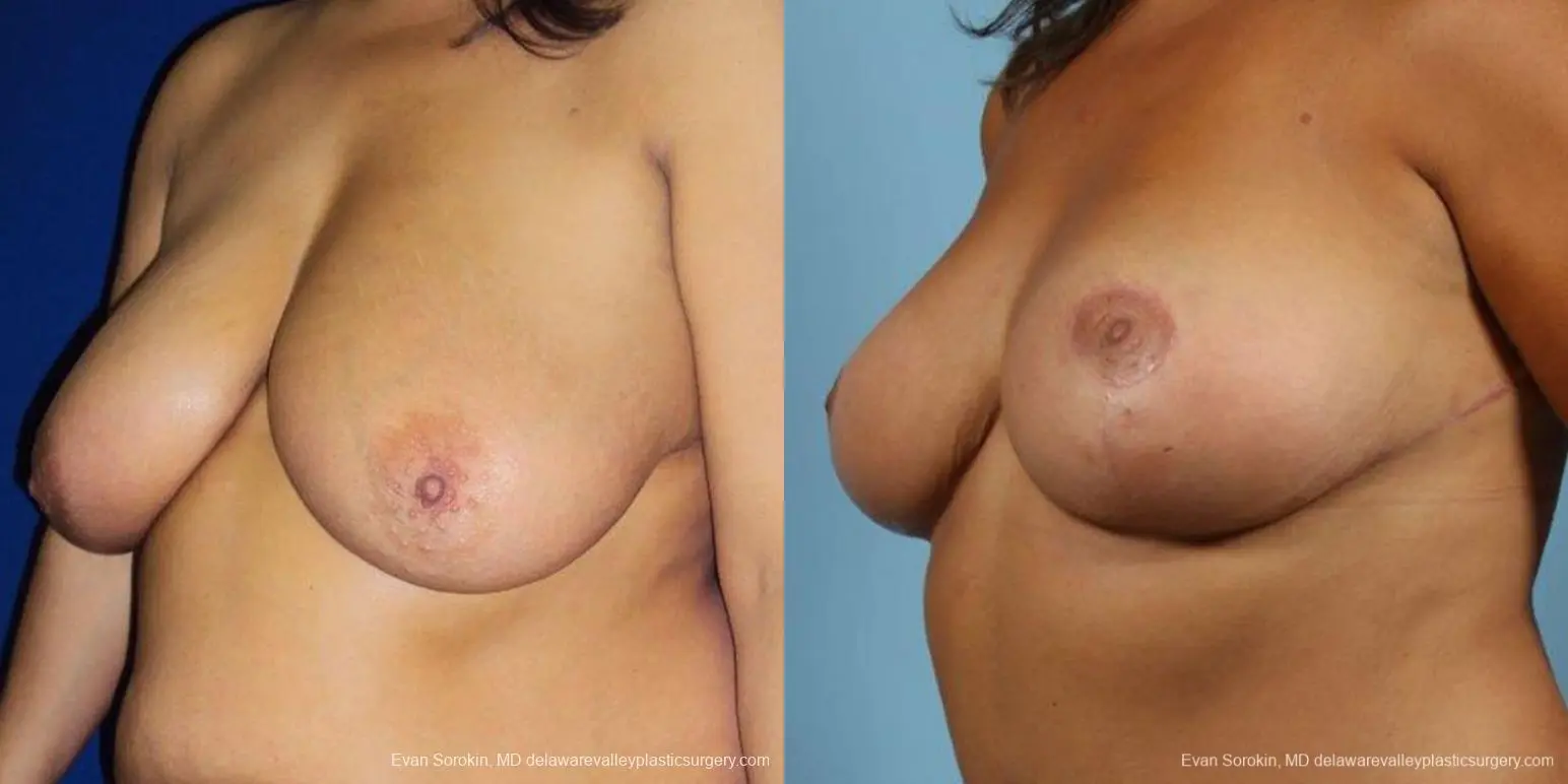 Philadelphia Breast Reduction 9470 - Before and After 2