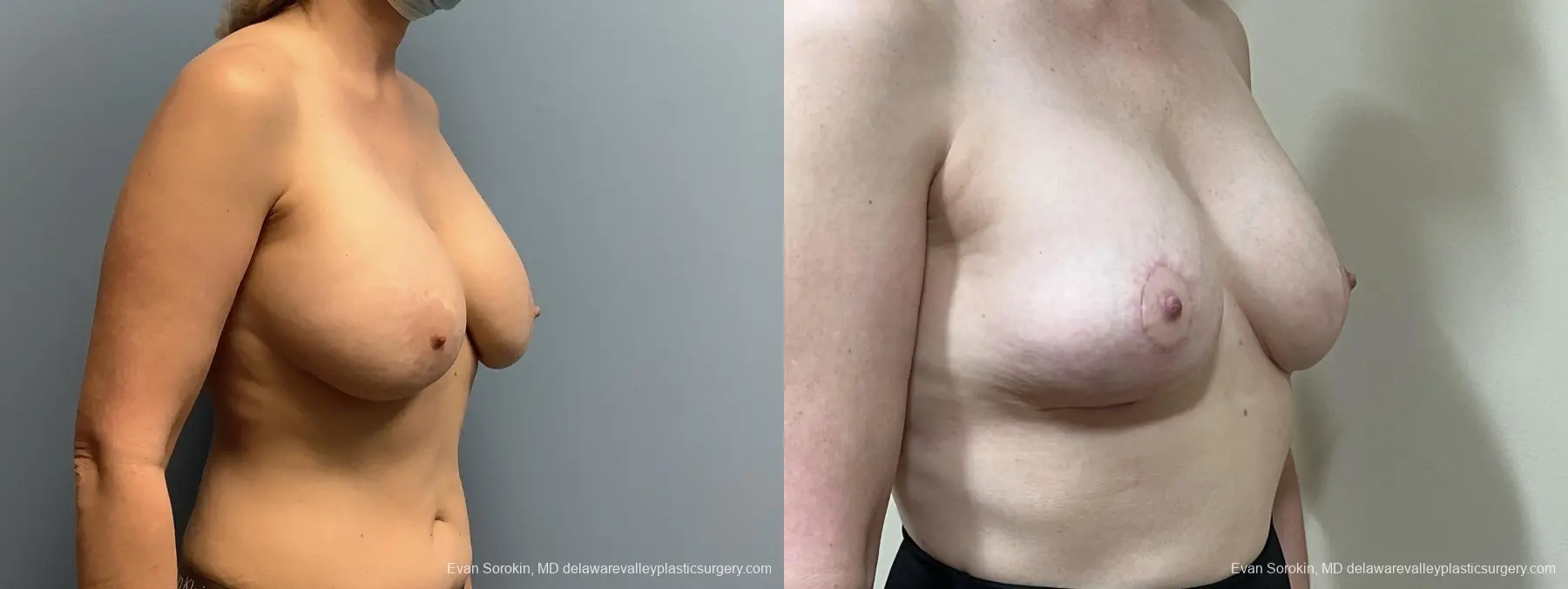 Breast Reduction: Patient 9 - Before and After 2