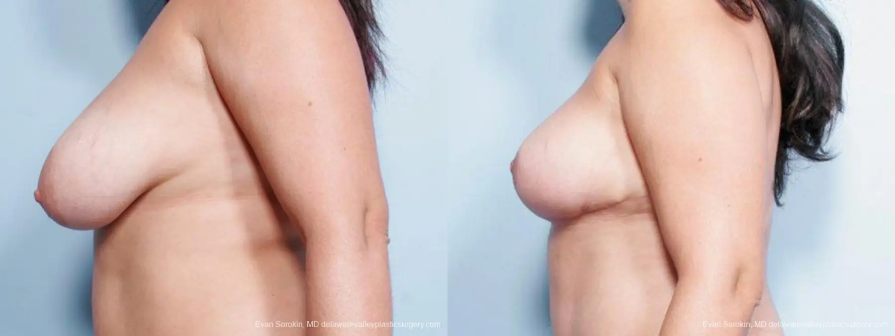 Philadelphia Breast Reduction 9441 - Before and After 5