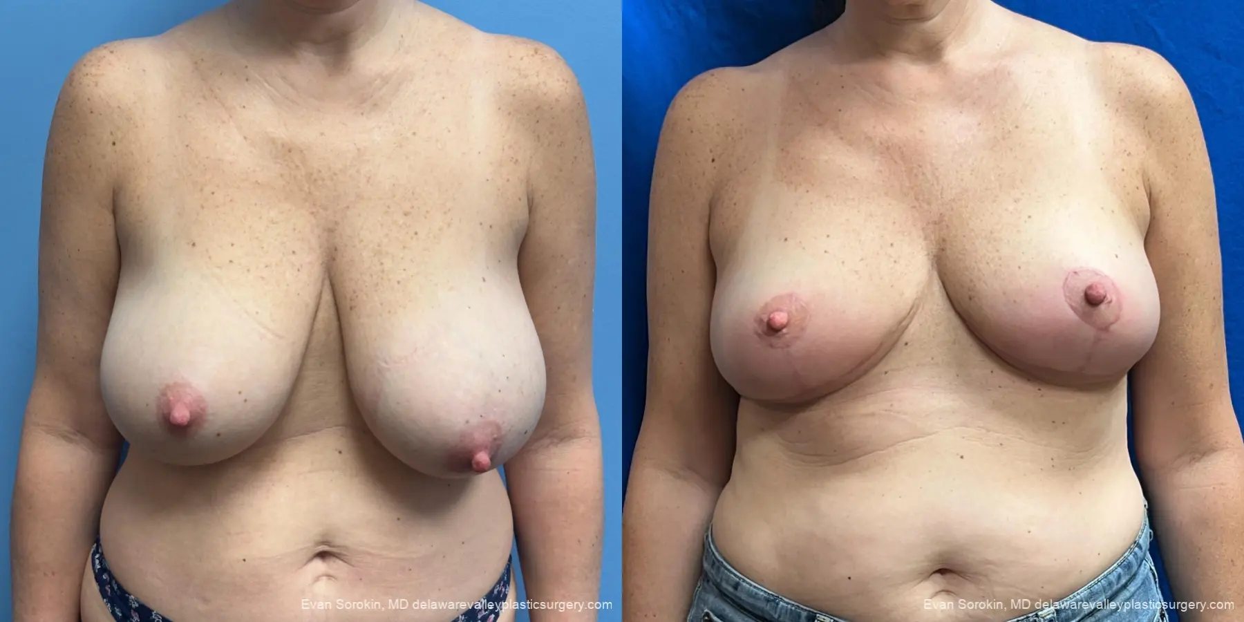 Breast Reduction: Patient 7 - Before and After  