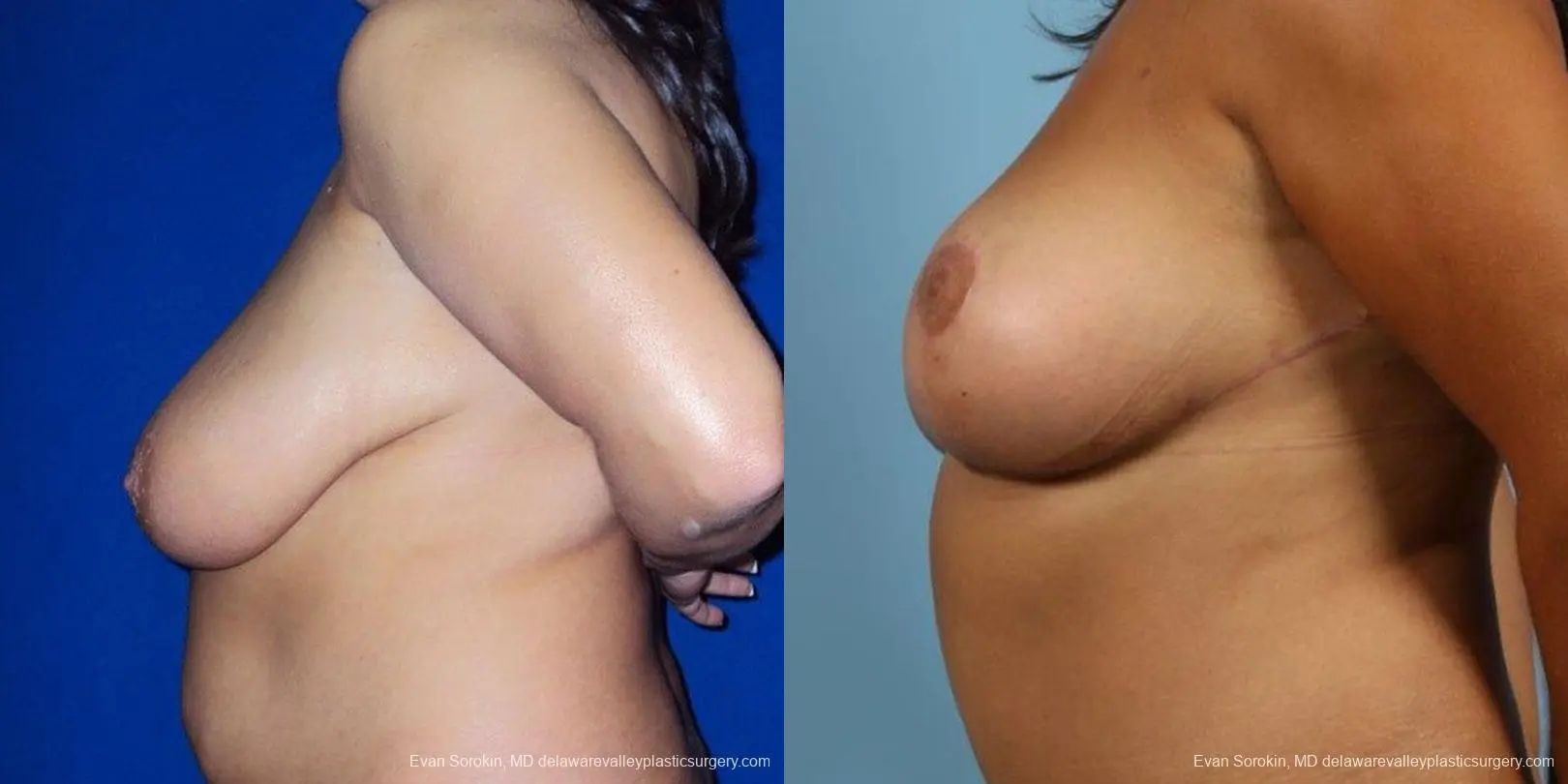 Philadelphia Breast Reduction 9470 - Before and After 3