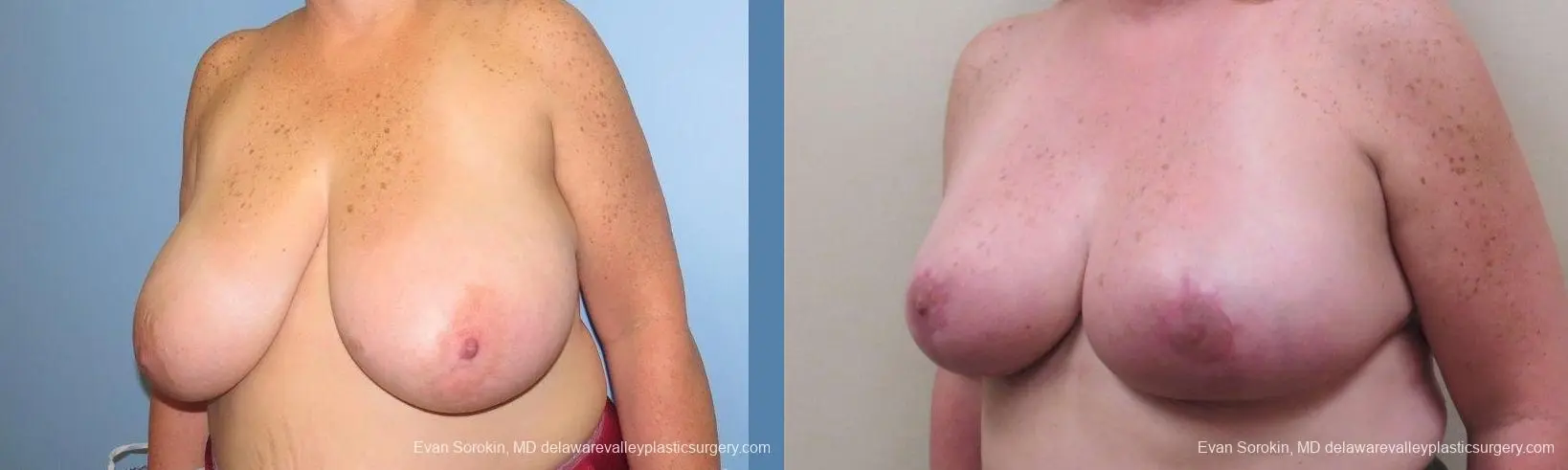 Philadelphia Breast Reduction 10118 - Before and After 4