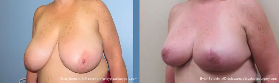 Philadelphia Breast Reduction 10118 - Before and After 4