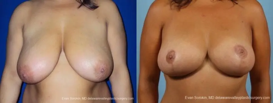 Philadelphia Breast Reduction 8701 - Before and After 1