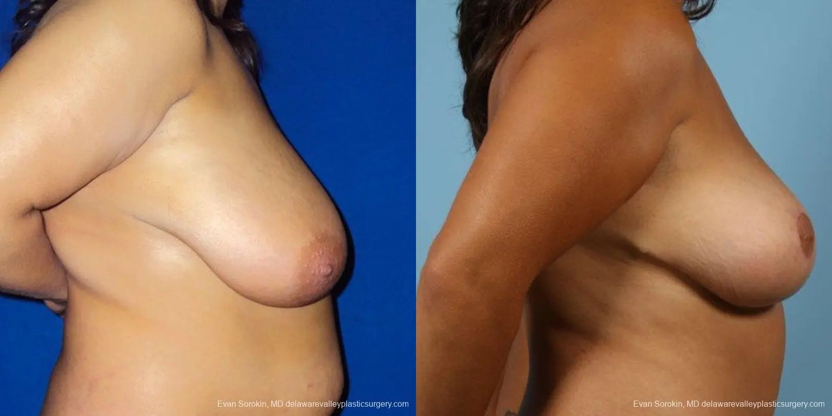 Philadelphia Breast Reduction 9470 - Before and After 5