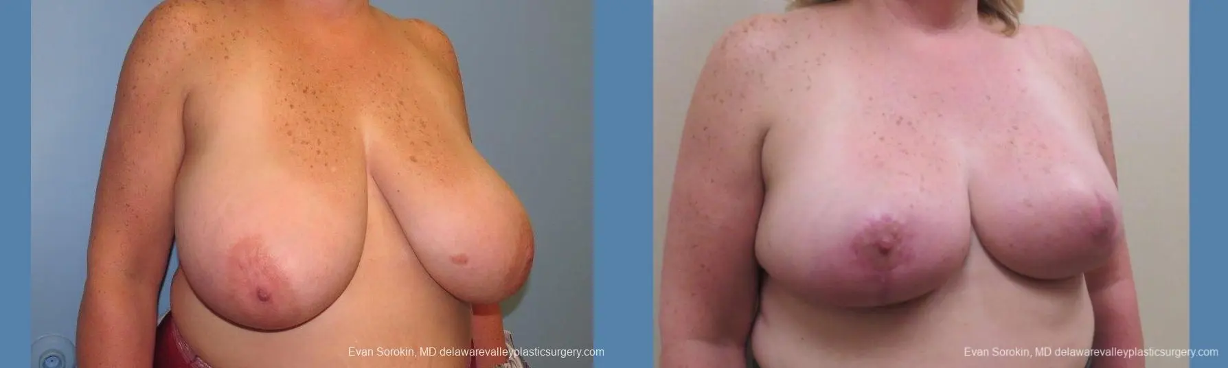 Philadelphia Breast Reduction 10118 - Before and After 2