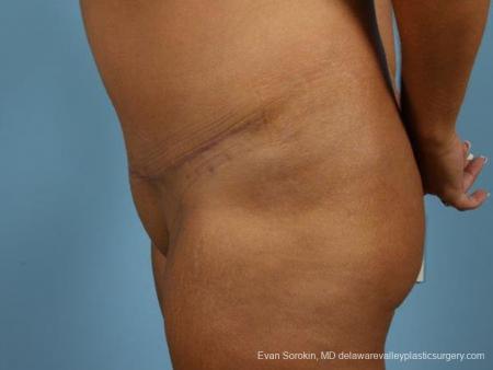 Philadelphia Abdominoplasty 9471 - After Image 5