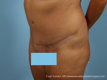 Philadelphia Abdominoplasty 8700 - After Image 3