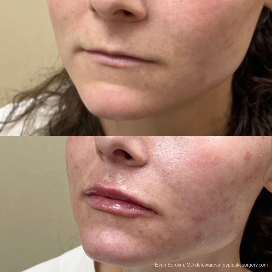 Lip Filler: Patient 28 - Before and After 3