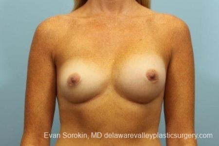 Philadelphia Breast Augmentation 8654 - Before Image 1