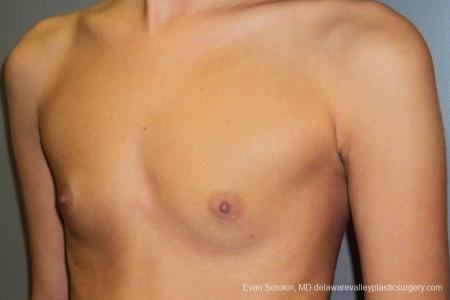 Philadelphia Breast Augmentation 8668 - Before Image 3
