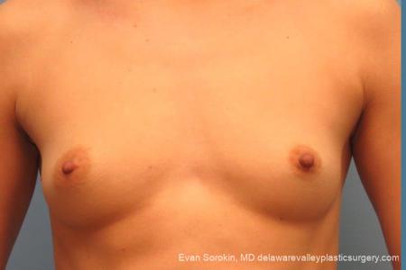 Philadelphia Breast Augmentation 10097 - Before Image 1