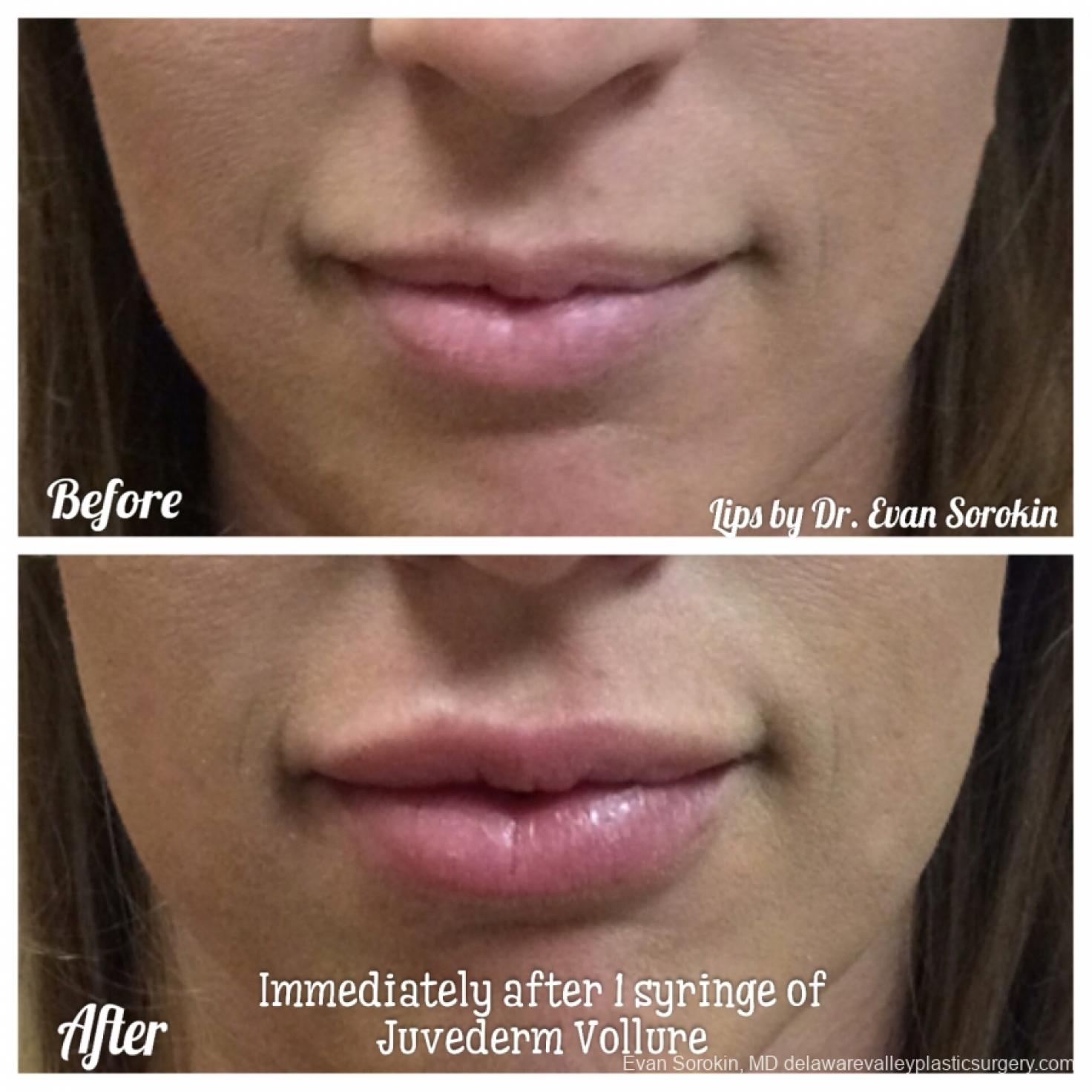 Lip Filler: Patient 39 - Before and After 1