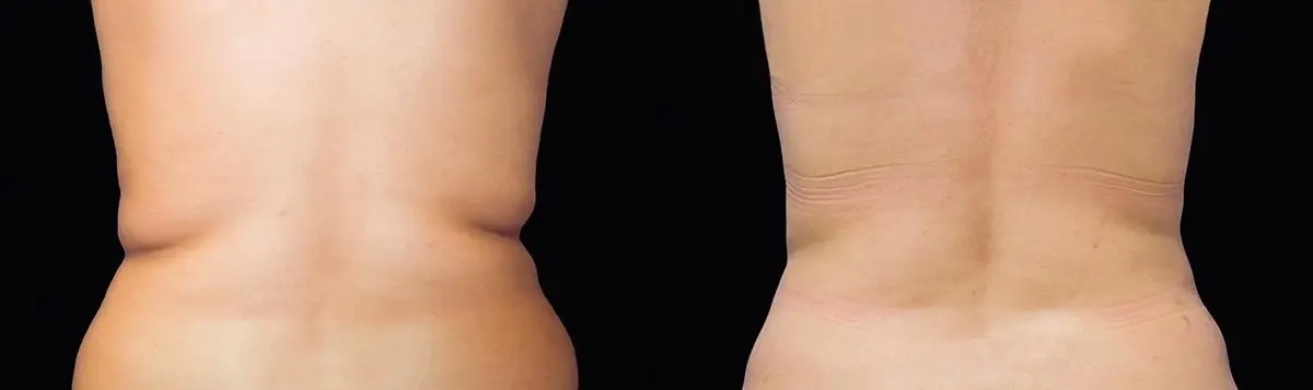 CoolSculpting®: Patient 14 - Before and After  