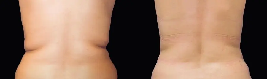 CoolSculpting®: Patient 14 - Before and After 1