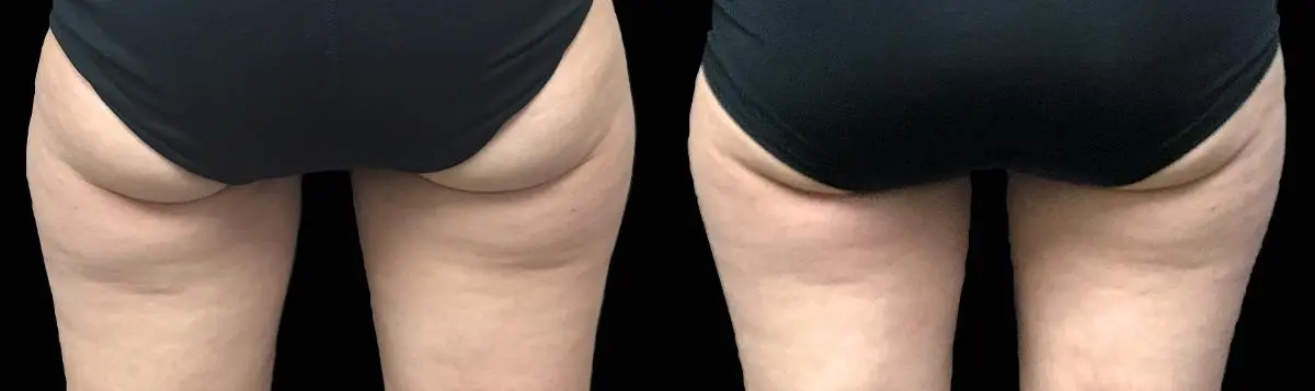 CoolSculpting®: Patient 15 - Before and After 1
