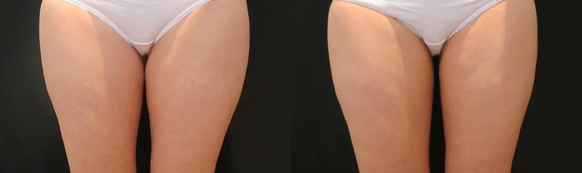 CoolSculpting®: Patient 8 - Before and After  