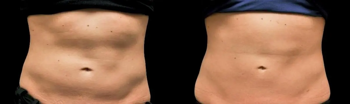 CoolSculpting®: Patient 4 - Before and After  