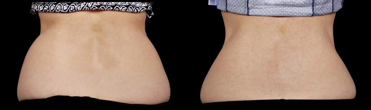 CoolSculpting®: Patient 11 - Before and After  