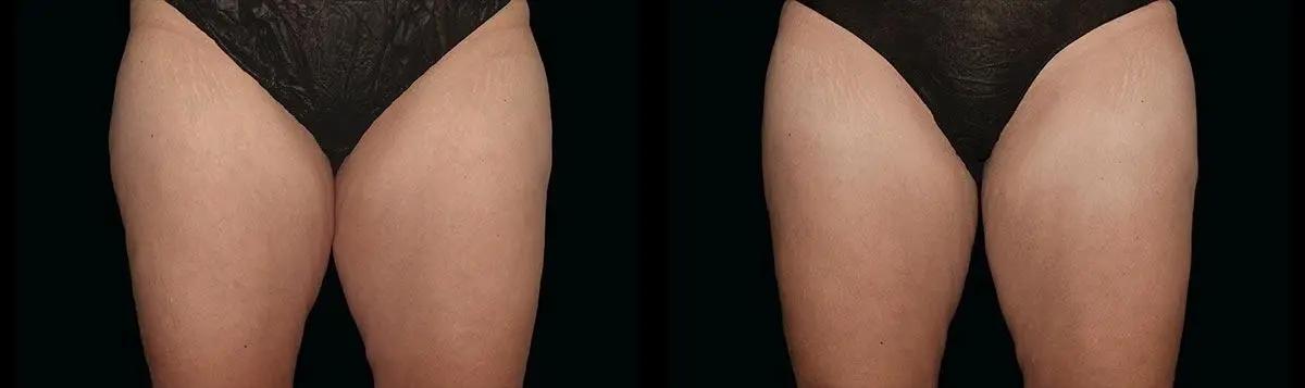 CoolSculpting®: Patient 12 - Before and After 1