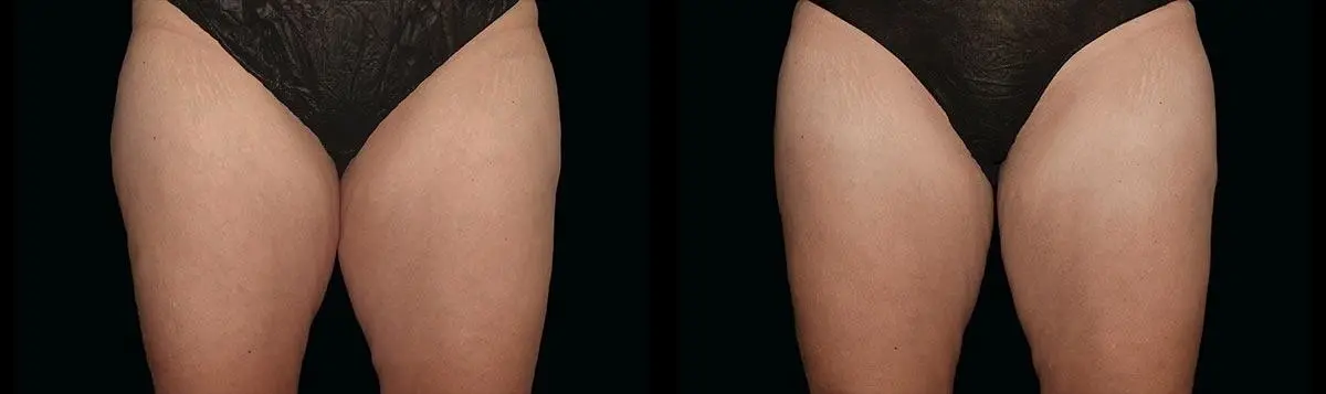 CoolSculpting®: Patient 12 - Before and After  