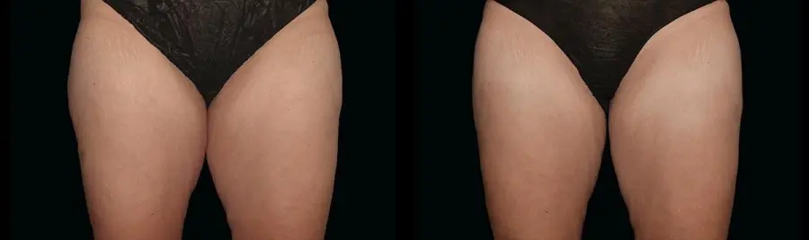 CoolSculpting®: Patient 12 - Before and After 1