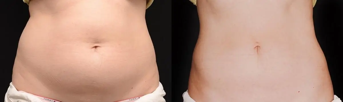 CoolSculpting®: Patient 3 - Before and After 1