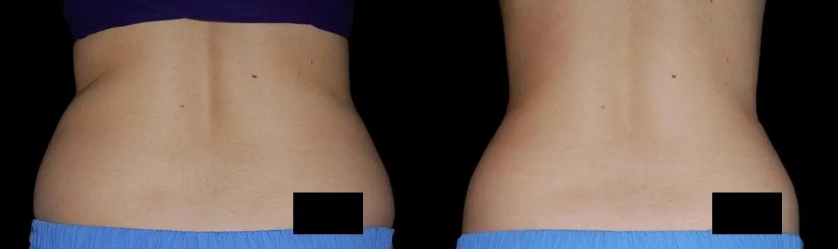 CoolSculpting®: Patient 13 - Before and After  