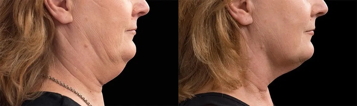 CoolSculpting®: Patient 4 - Before and After