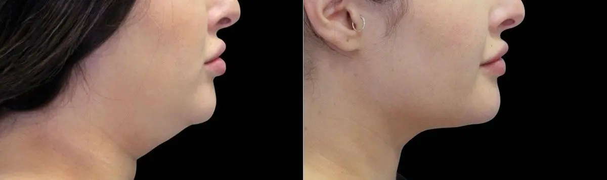 CoolSculpting®: Patient 7 - Before and After