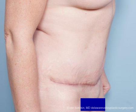 Philadelphia Abdominoplasty 9315 - After Image 4