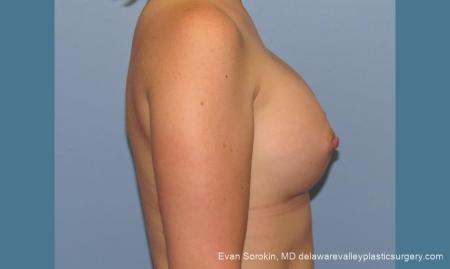 Philadelphia Breast Augmentation 10193 - After Image 3