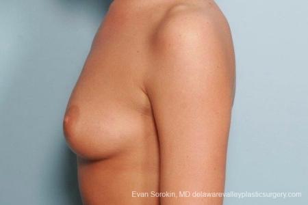 Philadelphia Breast Augmentation 8792 - Before and After Image 5