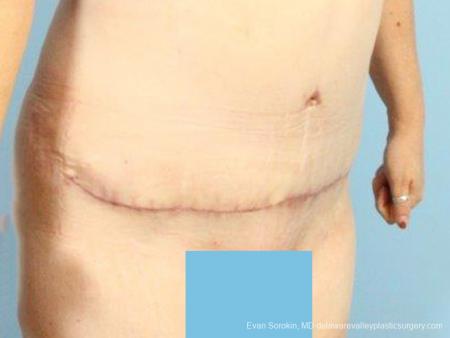 Philadelphia Abdominoplasty 9467 - After Image 2