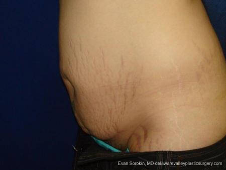 Philadelphia Abdominoplasty 9473 - Before and After Image 4