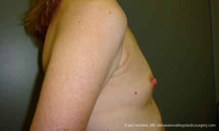 Philadelphia Breast Augmentation 9180 - Before Image 3