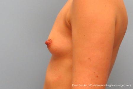 Philadelphia Breast Augmentation 8763 - Before and After Image 5